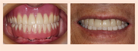 左：術後の口腔内写真、右：術後のスマイル時