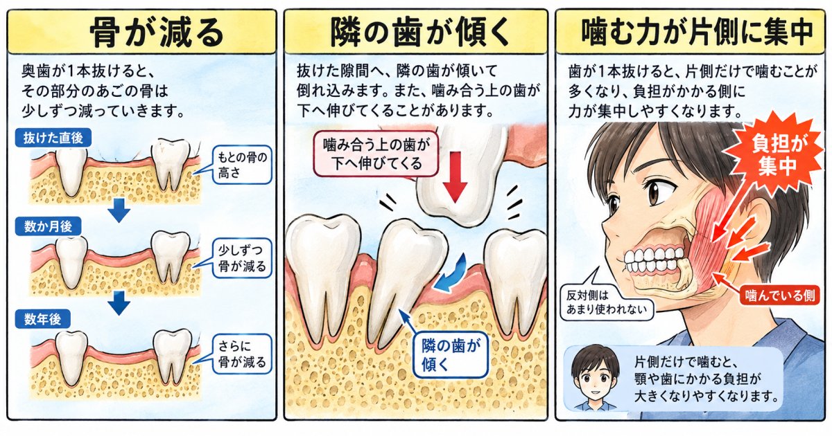 抜歯後数年の放置で生じる口の中の変化と手遅れではない根拠